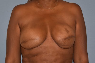 Breast Reconstruction Before & After Gallery - Patient 387876 - Image 1