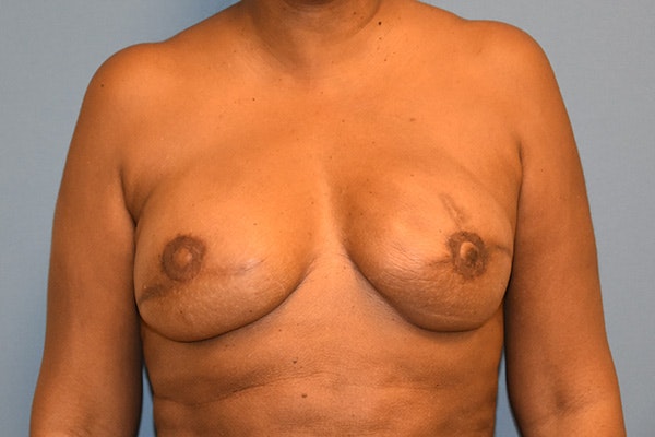 Breast Reconstruction Before & After Gallery - Patient 387876 - Image 2