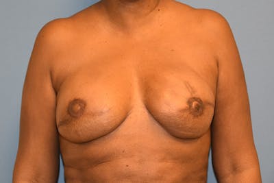 Breast Reconstruction Before & After Gallery - Patient 387876 - Image 2