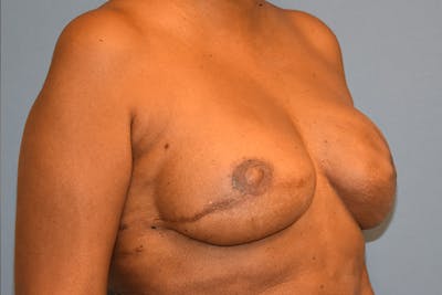 Breast Reconstruction Before & After Gallery - Patient 387876 - Image 4