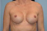 Breast Revision Before & After Gallery - Patient 143503 - Image 1