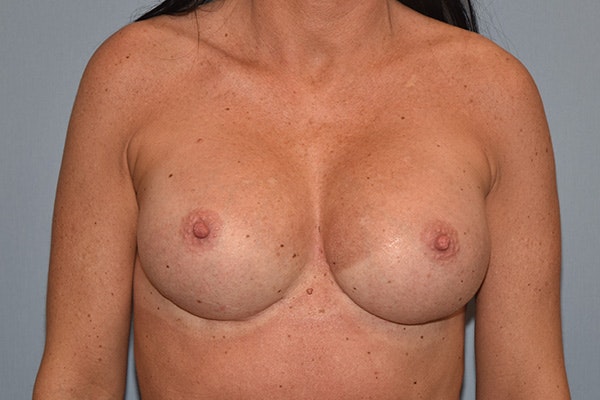Breast Revision Before & After Gallery - Patient 143503 - Image 2
