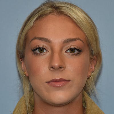 Rhinoplasty Before & After Gallery - Patient 220799 - Image 6
