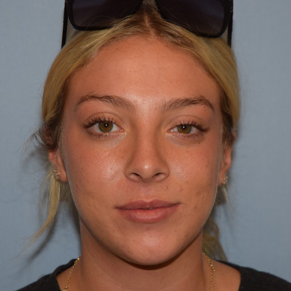 Rhinoplasty Before & After Gallery - Patient 220799 - Image 5