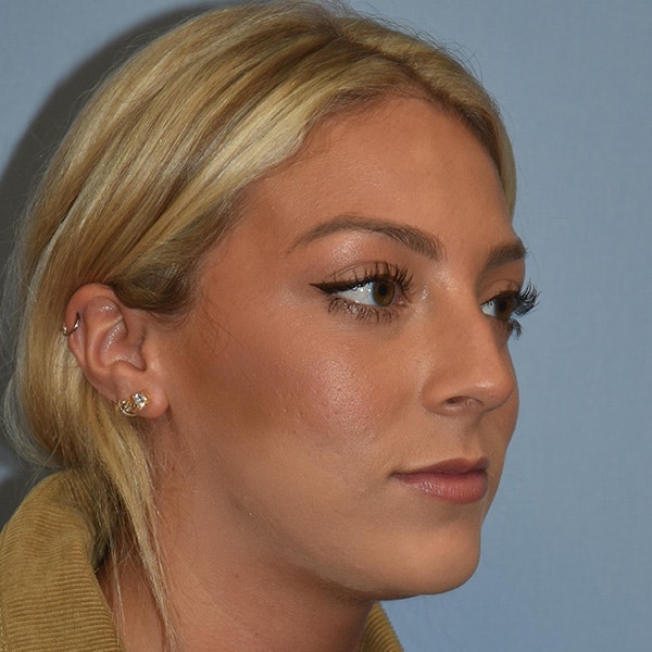 Rhinoplasty Before & After Gallery - Patient 220799 - Image 3