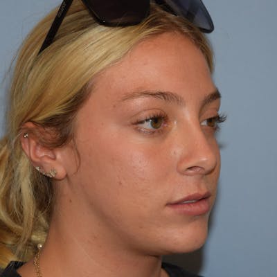 Rhinoplasty Before & After Gallery - Patient 220799 - Image 4