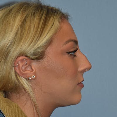 Rhinoplasty Before & After Gallery - Patient 220799 - Image 1