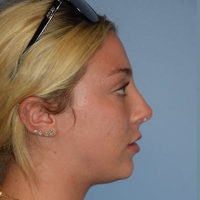 Rhinoplasty Before & After Gallery - Patient 220799 - Image 2