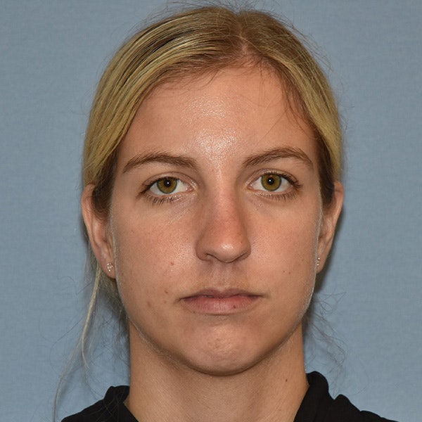 Rhinoplasty Before & After Gallery - Patient 423597 - Image 1