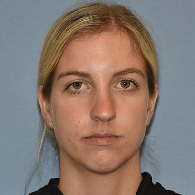 Rhinoplasty Before & After Gallery - Patient 423597 - Image 1
