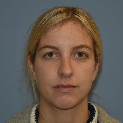 Rhinoplasty Before & After Gallery - Patient 423597 - Image 2