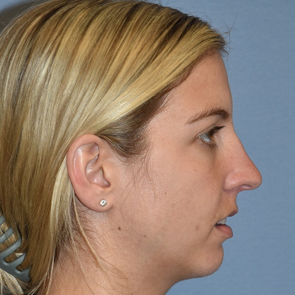 Rhinoplasty Before & After Gallery - Patient 423597 - Image 3