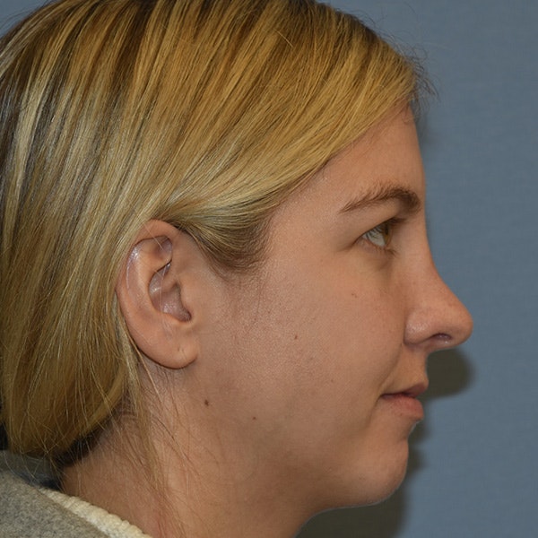 Rhinoplasty Before & After Gallery - Patient 423597 - Image 4