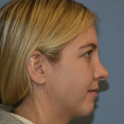 Rhinoplasty Before & After Gallery - Patient 423597 - Image 4