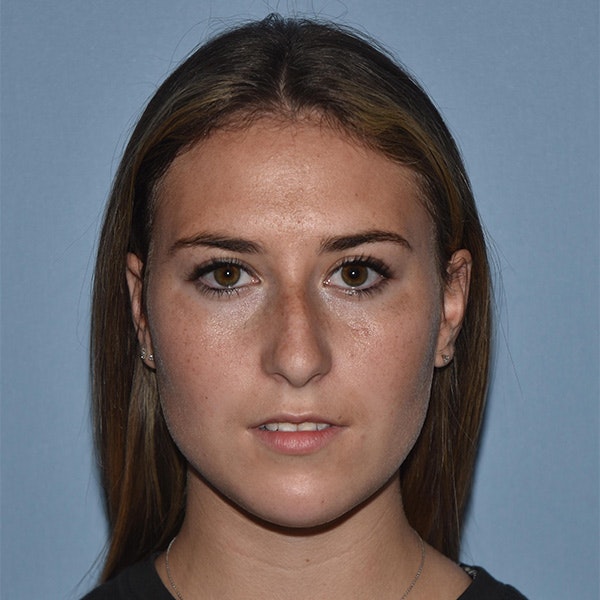 Rhinoplasty Before & After Gallery - Patient 328683 - Image 5