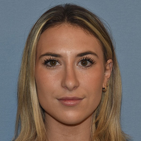 Rhinoplasty Before & After Gallery - Patient 328683 - Image 6
