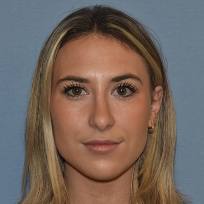 Rhinoplasty Before & After Gallery - Patient 328683 - Image 6