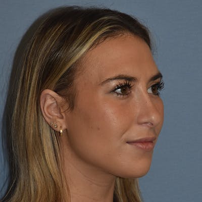 Rhinoplasty Before & After Gallery - Patient 328683 - Image 4