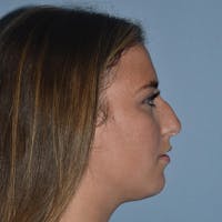 Rhinoplasty Before & After Gallery - Patient 328683 - Image 1