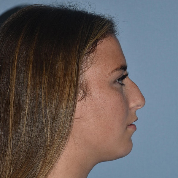 Rhinoplasty Before & After Gallery - Patient 328683 - Image 1
