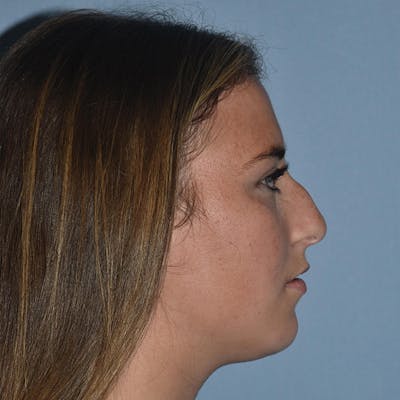 Rhinoplasty Before & After Gallery - Patient 328683 - Image 1