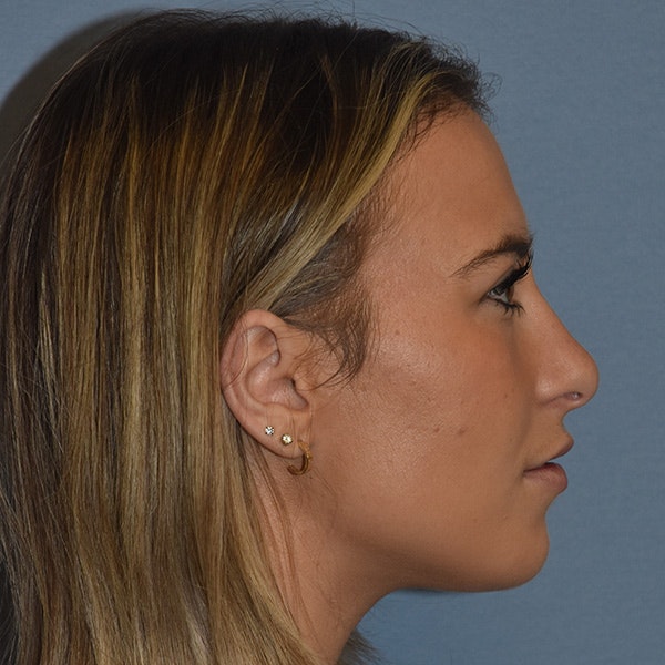 Rhinoplasty Before & After Gallery - Patient 328683 - Image 2