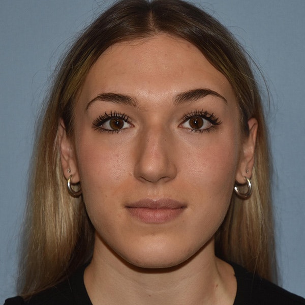 Rhinoplasty Before & After Gallery - Patient 326865 - Image 5