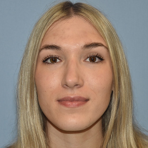 Rhinoplasty Before & After Gallery - Patient 326865 - Image 6