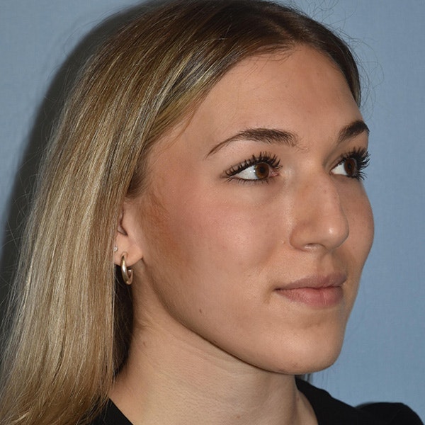Rhinoplasty Before & After Gallery - Patient 326865 - Image 3