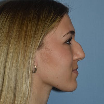 Rhinoplasty Before & After Gallery - Patient 326865 - Image 1