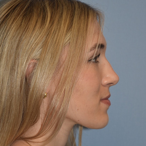 Rhinoplasty Before & After Gallery - Patient 326865 - Image 2