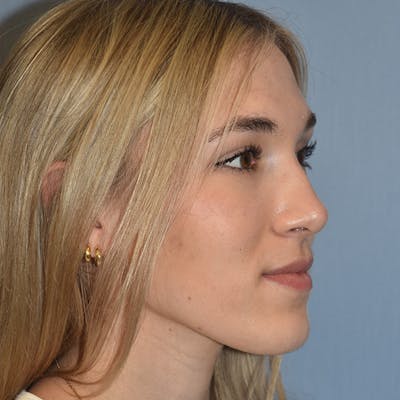 Rhinoplasty Before & After Gallery - Patient 326865 - Image 4