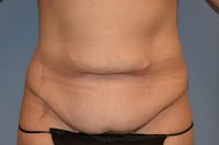 Tummy Tuck Before & After Gallery - Patient 128440 - Image 1