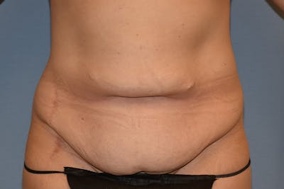 Tummy Tuck Before & After Gallery - Patient 128440 - Image 1