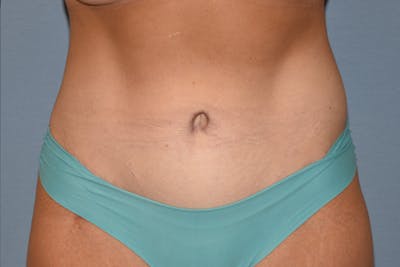 Tummy Tuck Before & After Gallery - Patient 128440 - Image 2