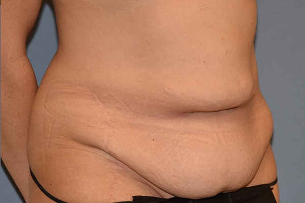 Tummy Tuck Before & After Gallery - Patient 128440 - Image 3
