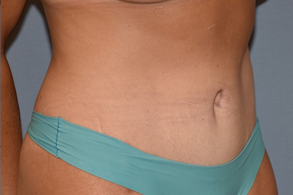 Tummy Tuck Before & After Gallery - Patient 128440 - Image 4