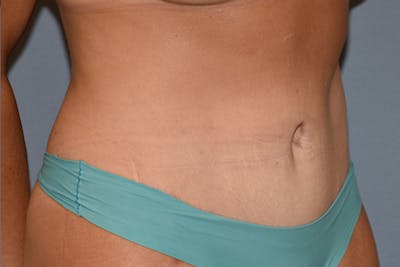 Tummy Tuck Before & After Gallery - Patient 128440 - Image 4