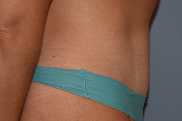 Tummy Tuck Before & After Gallery - Patient 128440 - Image 6