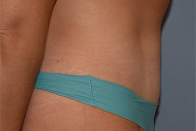 Tummy Tuck Before & After Gallery - Patient 128440 - Image 6