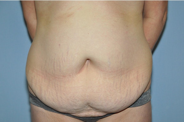 Tummy Tuck Before & After Gallery - Patient 322933 - Image 1