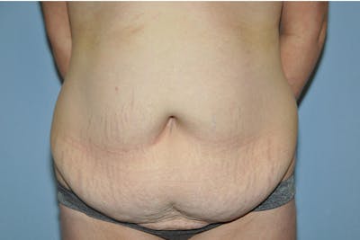 Tummy Tuck Before & After Gallery - Patient 322933 - Image 1