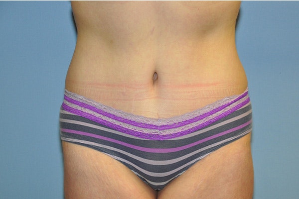Tummy Tuck Before & After Gallery - Patient 322933 - Image 2