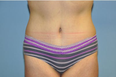Tummy Tuck Before & After Gallery - Patient 322933 - Image 2