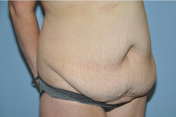 Tummy Tuck Before & After Gallery - Patient 322933 - Image 3
