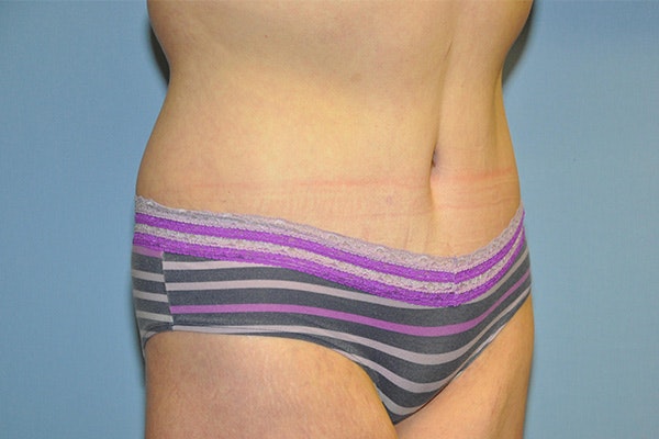 Tummy Tuck Before & After Gallery - Patient 322933 - Image 4
