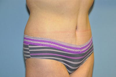 Tummy Tuck Before & After Gallery - Patient 322933 - Image 4
