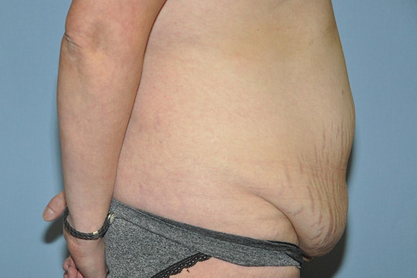 Tummy Tuck Before & After Gallery - Patient 322933 - Image 5