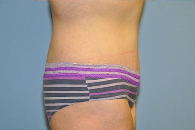 Tummy Tuck Before & After Gallery - Patient 322933 - Image 6