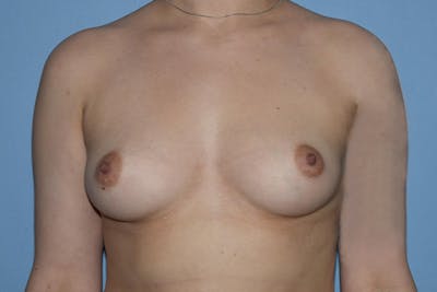 Breast Augmentation Before & After Gallery - Patient 387942 - Image 1
